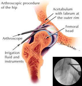 Schematic of Hip Keyhole Surgery